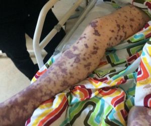 Meningitis_rash 2.jpg