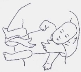 Torticollisinarms.jpg